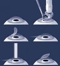 EpiLASIK laser vision correction. All about this method. We offer